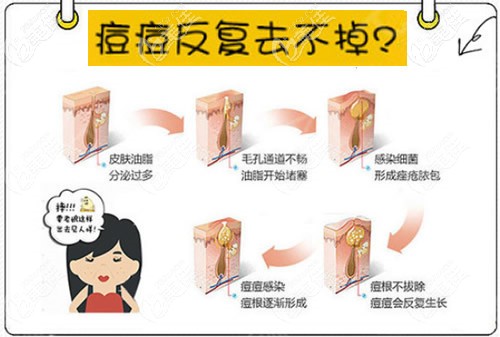 痘痘反復(fù)去不掉 痘痘反復(fù)去不掉
