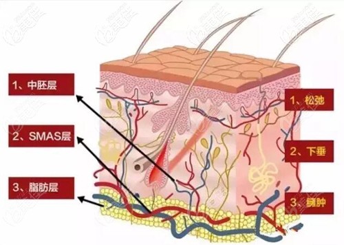 熱拉提能達(dá)到的層次 熱拉提能達(dá)到的層次
