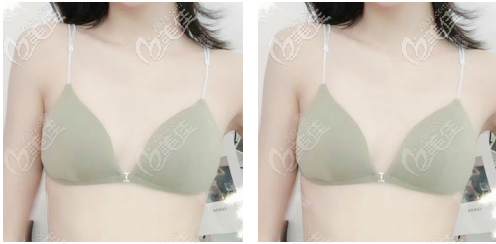 聽說深圳軍科劉月更隆胸技術(shù)好就來面診了 聽說深圳軍科劉月更隆胸技術(shù)好就來面診了