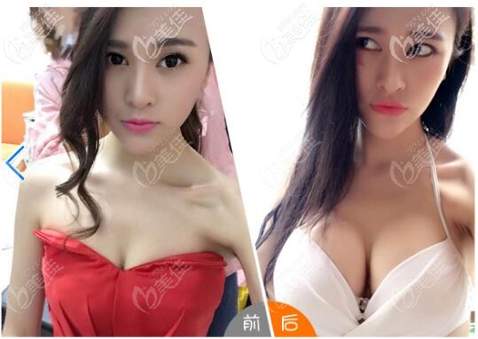 在深圳軍科做隆胸前后對比案例