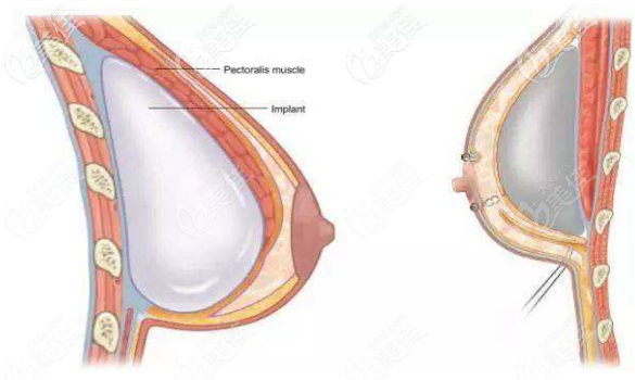 假體隆胸的位置
