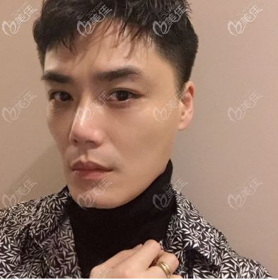 看我在廣州市佳人整形醫(yī)院做的假體墊眉弓效果怎么樣 看我在廣州市佳人整形醫(yī)院做的假體墊眉弓效果怎么樣