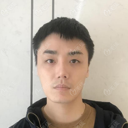 分享我做假體墊眉弓的親身經(jīng)歷 分享我做假體墊眉弓的親身經(jīng)歷