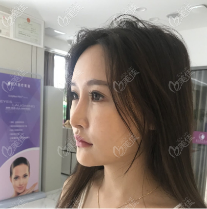 給你看看我做假體墊眉弓術前照片 給你看看我做假體墊眉弓術前照片