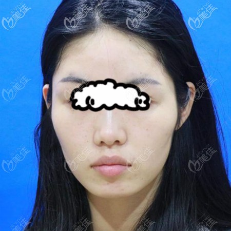 在武漢亞韓整形找趙貴慶做顴骨顴弓內(nèi)推和長曲線下頜角截骨術(shù)前照片 在武漢亞韓整形找趙貴慶做顴骨顴弓內(nèi)推和長曲線下頜角截骨術(shù)前照片