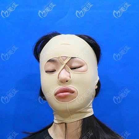 亞韓趙貴慶給我做顴骨和下頜角手術(shù)第4天效果圖片 亞韓趙貴慶給我做顴骨和下頜角手術(shù)第4天效果圖片