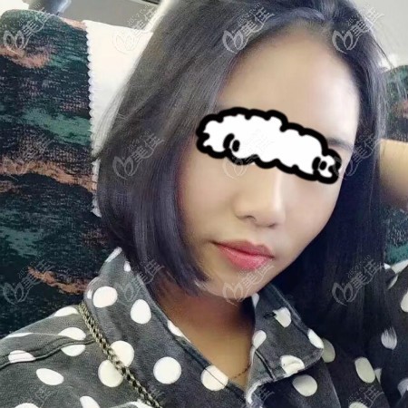 我找武漢亞韓趙貴慶做顴骨+下頜角手術(shù)恢復2個月效果 我找武漢亞韓趙貴慶做顴骨+下頜角手術(shù)恢復2個月效果