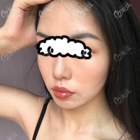 在武漢亞韓找趙貴慶做顴骨顴弓降低和下頜角磨骨手術(shù)恢復6個月效果 在武漢亞韓找趙貴慶做顴骨顴弓降低和下頜角磨骨手術(shù)恢復6個月效果