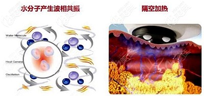 熱拉提具有消脂的作用 熱拉提具有消脂的作用