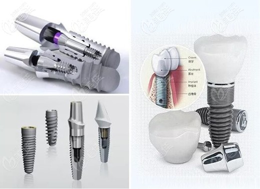 德國ICX種植體 德國ICX種植體
