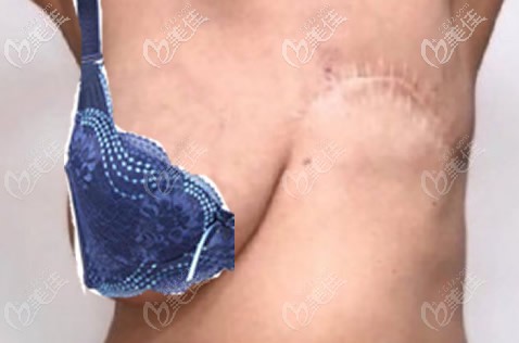 乳腺癌切除一側(cè)乳房