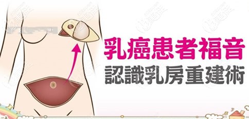 乳房重建可以重新塑造乳房