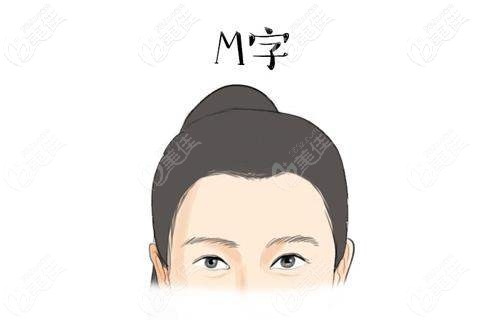 m型發(fā)際線示例圖片 m型發(fā)際線示例圖片