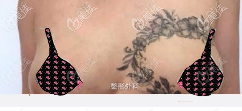 乳房重建后的效果圖