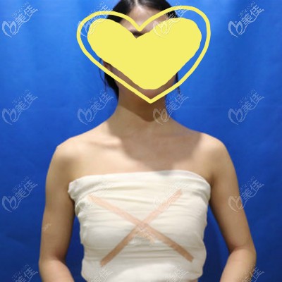 武漢亞韓鄧正輝醫(yī)生給我做進(jìn)口曼托假體隆胸術(shù)后即刻<span style= 武漢亞韓鄧正輝醫(yī)生給我做進(jìn)口曼托假體隆胸術(shù)后即刻<span style=