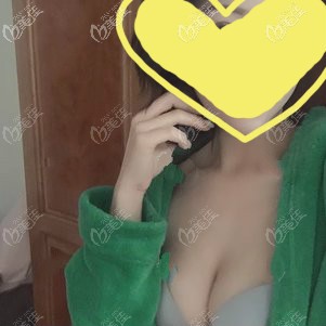 我在武漢亞韓做美國(guó)曼托245cc假體隆胸術(shù)后20天<span style= 我在武漢亞韓做美國(guó)曼托245cc假體隆胸術(shù)后20天<span style=