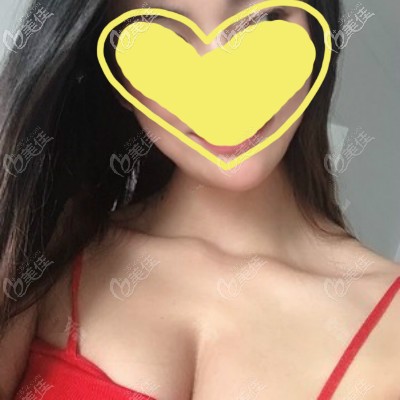 武漢亞韓醫(yī)生為我做的美國曼托水滴型245cc假體隆胸,恢復三個月后手感柔軟自然