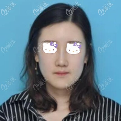 鼻整形術(shù)后12天效果 鼻整形術(shù)后12天效果