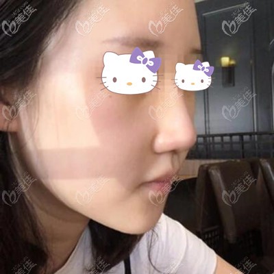 做鼻整形術(shù)后18天效果照 做鼻整形術(shù)后18天效果照