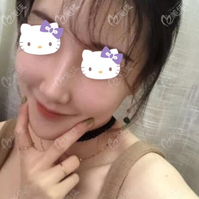 做鼻整形1個月的恢復(fù)效果照 做鼻整形1個月的恢復(fù)效果照