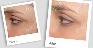 進(jìn)口玻尿酸去除魚尾紋案例 進(jìn)口玻尿酸去除魚尾紋案例