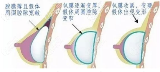 隆胸假體出現(xiàn)包膜攣縮