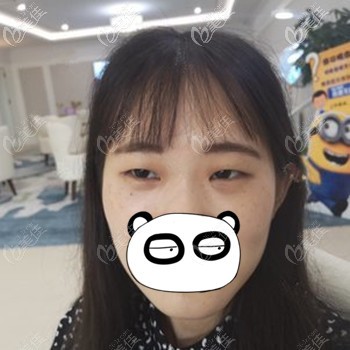 做眼綜合前眼睛有上瞼下垂的情況 做眼綜合前眼睛有上瞼下垂的情況