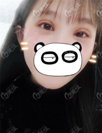 做眼綜合后的前半個月處于腫脹期 做眼綜合后的前半個月處于腫脹期