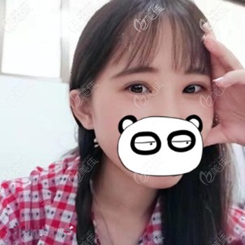 做了眼綜合后朋友感慨：術后雙眼皮有了上瞼下垂也改善了簡直一舉兩得呀！