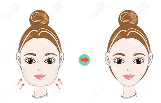 激光溶脂瘦臉效果