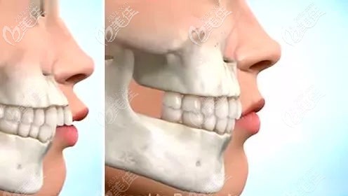 骨性齙牙除了正頜手術還能怎么治療 骨性齙牙除了正頜手術還能怎么治療