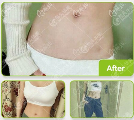 包頭華美抽脂案例:腰腹環(huán)吸一個(gè)月我每天都量肚子,就想看腰圍細(xì)了多少!