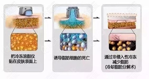酷塑冷凍減脂的原理