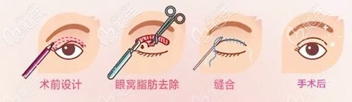 腫眼泡做全切雙眼皮手術(shù)過程