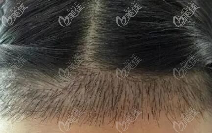 前額發(fā)際線植發(fā)效果