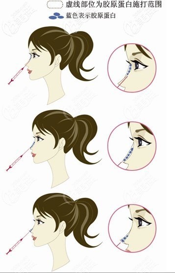 膠原蛋白注射隆鼻 膠原蛋白注射隆鼻