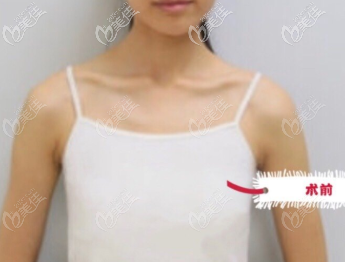 到杭州藝星做假體隆胸前 到杭州藝星做假體隆胸前