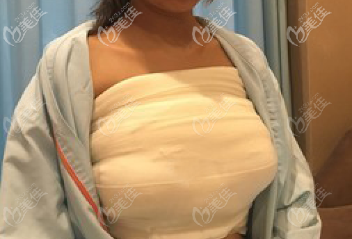 假體隆胸術(shù)后恢復(fù)三天 假體隆胸術(shù)后恢復(fù)三天