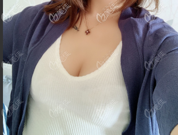 假體隆胸術(shù)后7天到醫(yī)院拆線 假體隆胸術(shù)后7天到醫(yī)院拆線