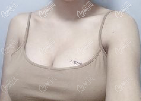 杭州藝星付德剛假體隆胸恢復(fù)一個(gè)月<span style= 杭州藝星付德剛假體隆胸恢復(fù)一個(gè)月<span style=