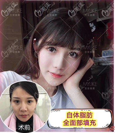 北京美萊王志強全臉脂肪填充案例