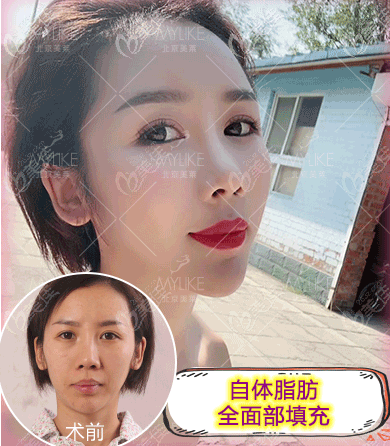 北京美萊全臉脂肪填充哪個醫(yī)生好？宋延剛醫(yī)生面部脂肪填充案例參考