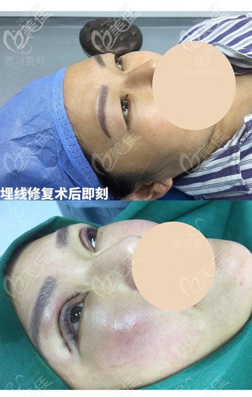 初次埋線重瞼術(shù)后3個月埋線脫落，重新做了切開雙眼皮+去脂的術(shù)后即刻對比照