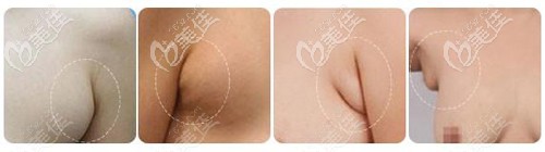 各種副乳的圖片