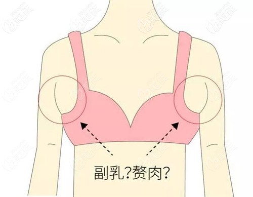 副乳和贅肉有區(qū)別