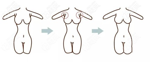 副乳切除手術(shù)過程