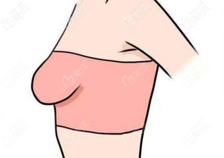 乳房松弛下垂很厲害需要提胸 乳房松弛下垂很厲害需要提胸