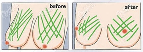 人工韌帶乳房提升效果 人工韌帶乳房提升效果