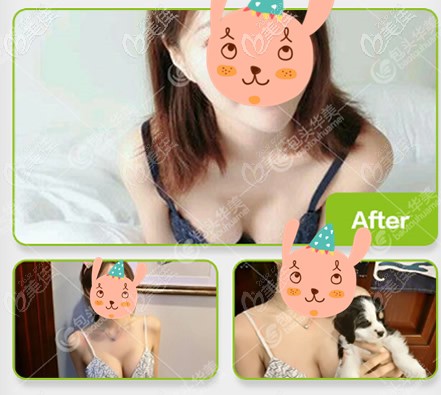 大家看過我曼托圓盤250隆胸前后圖片后,都說我花2萬多做的假體隆胸一點(diǎn)也不虧!