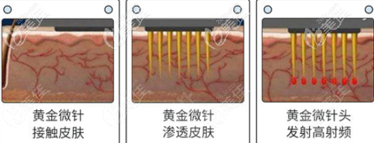 黃金微針去痘坑過(guò)程示意圖
